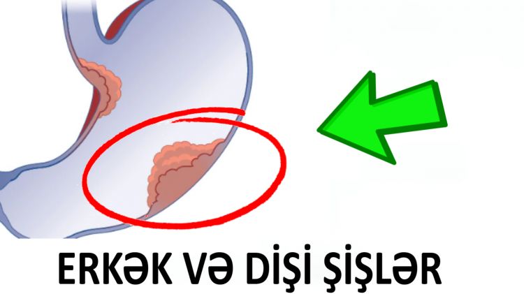 Erkək və Dişi şişlər nədir?  - Dr Elşən Qədimov