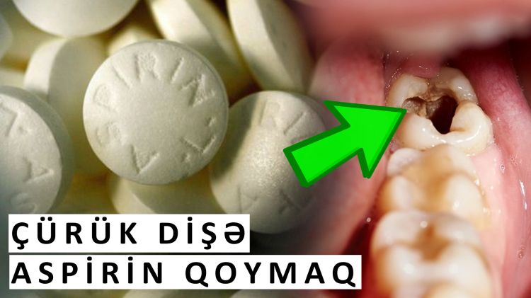 Aspirin çürük dişi müalicə edirmi? - İZLƏYİN